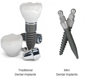 Examples of Dental Implants & Mini Dental Implants